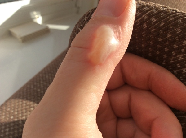 Burnt my thump