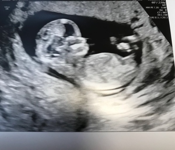 Thread no.2 for babies due April 2018