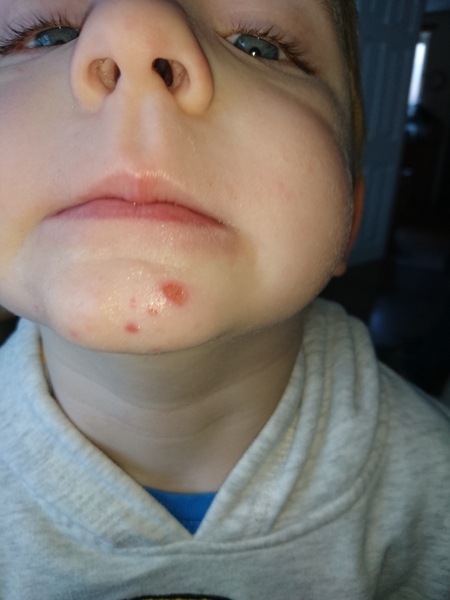 Chin spots?
