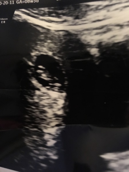 7 weeks pregnant no heartbeat