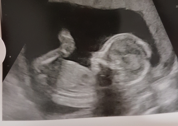 Just for fun - 20wk scan