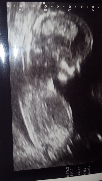 Nub theory anyone? 13 weeks