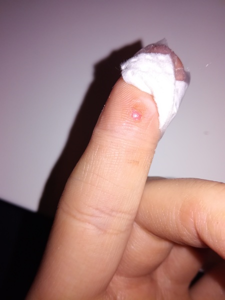 9 year old wart fell off (pic)