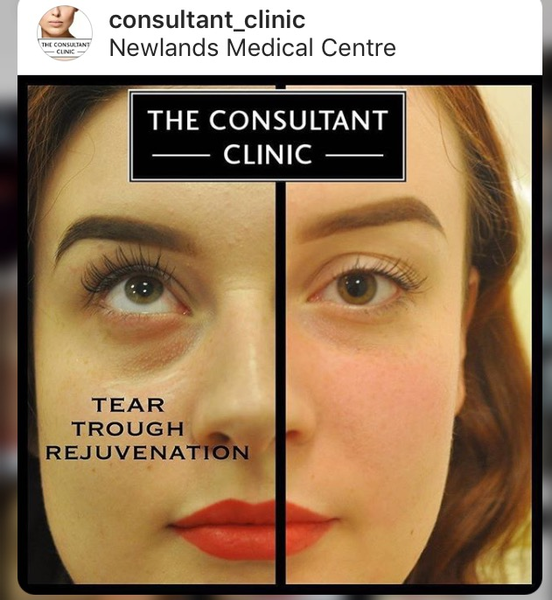 Terrible dark circles under eyes - drastic action needed!