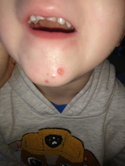 Chin spots?