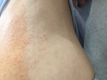 Gallbladder removal - digestive support ?