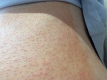 Gallbladder removal - digestive support ?