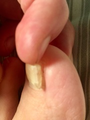 Help - Toenail falling off!