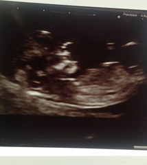 SCAN AT 14 WEEKS, Can they tell the SEX OF THE BABY ???