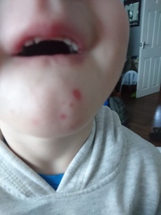Chin spots?