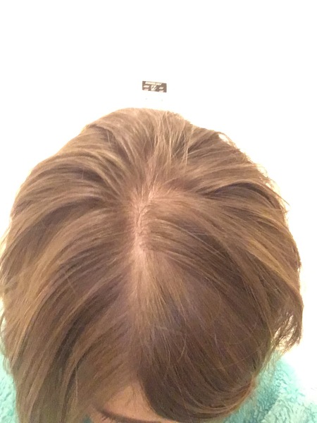 Hair loss support thread