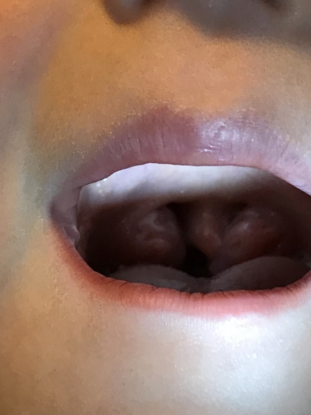 Enlarged tonsils in 5 year old