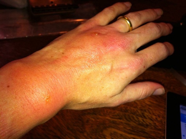 Arm swollen up after being bitten by an insect. What can I do?