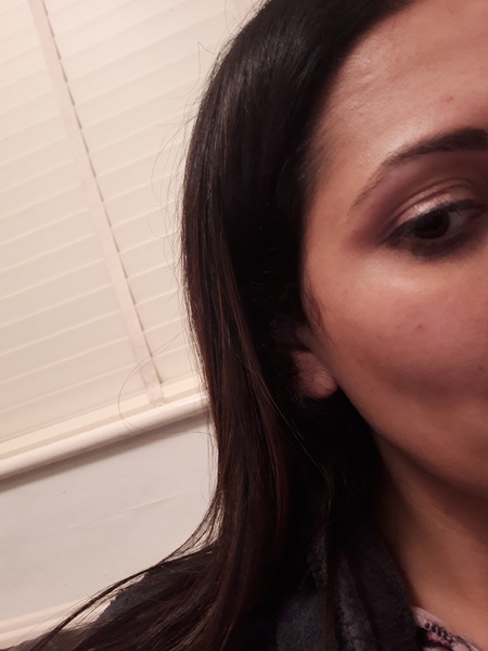 to be considering under eye fillers?!