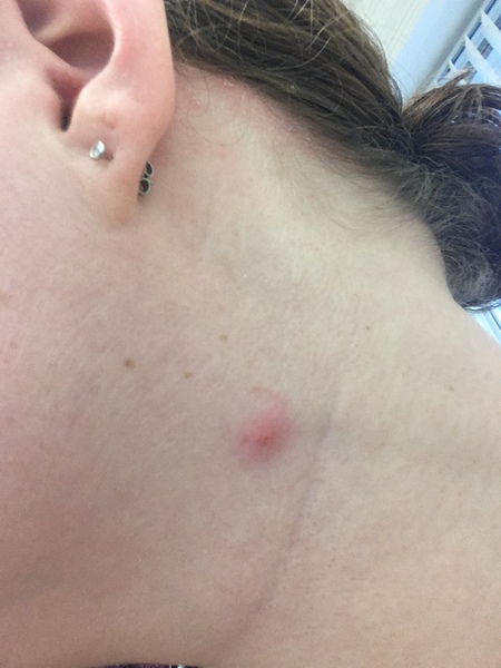 Promising spot on neck