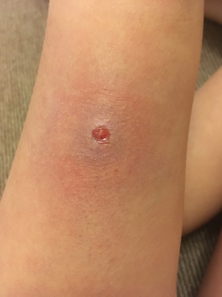 Infected hair (pictures included)
