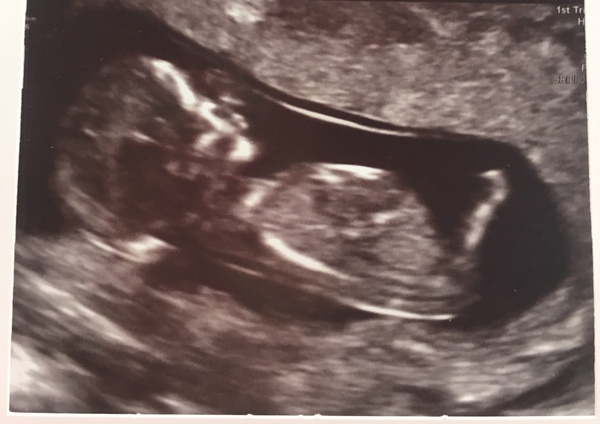 May 2018 thread 3, 12 week scans and heading towards the 2nd trimester