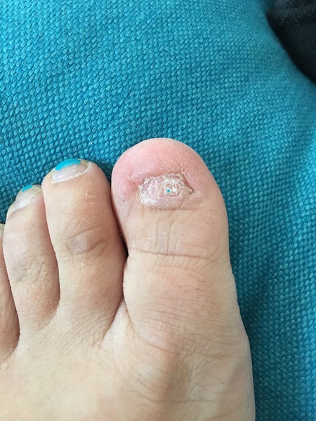 Had my fourth toe toenail taken off. None of my friends want to see it so sharing here