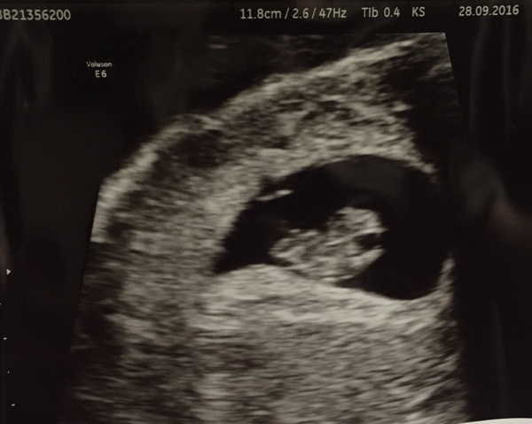 9 week scan.