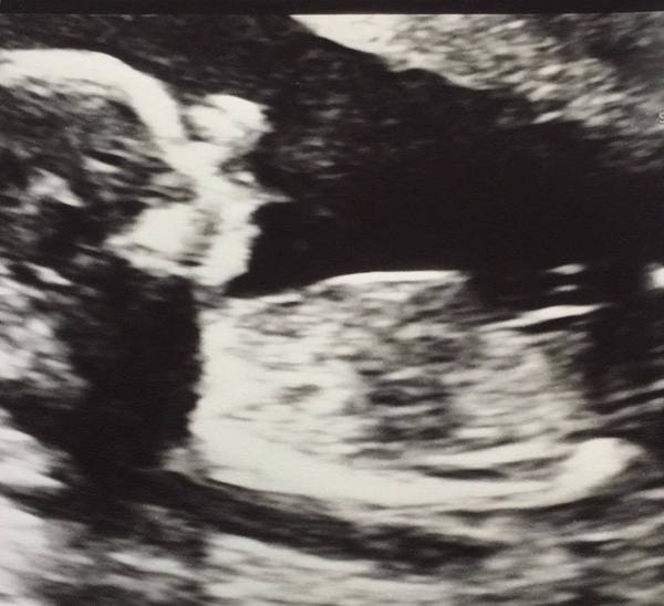 boy or a girl guess 18 weeks (pic attached)