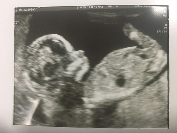 #makeithappen TTC through Donor IUI or Donor IVF or just undecided. All welcome. Thread 10