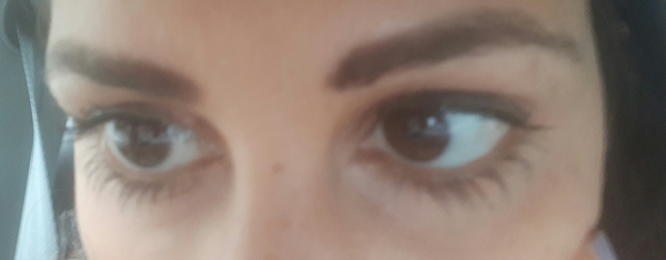 to be considering under eye fillers?!