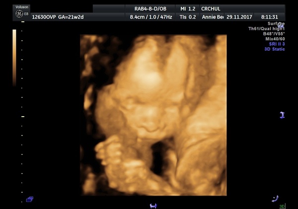 Pregnancies due April 2018