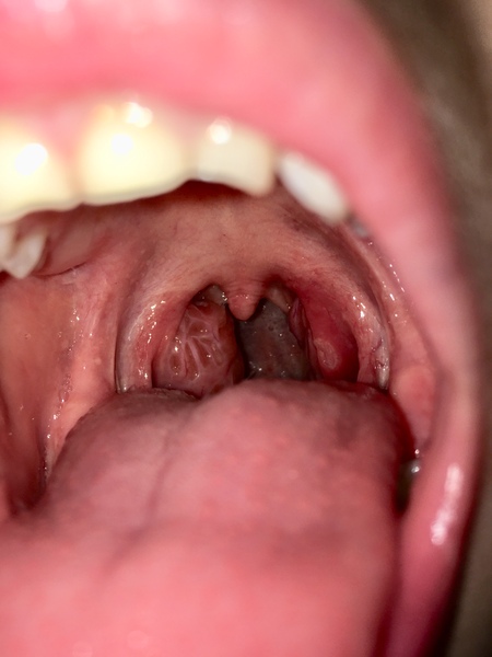 Photo included - tonsillitis?