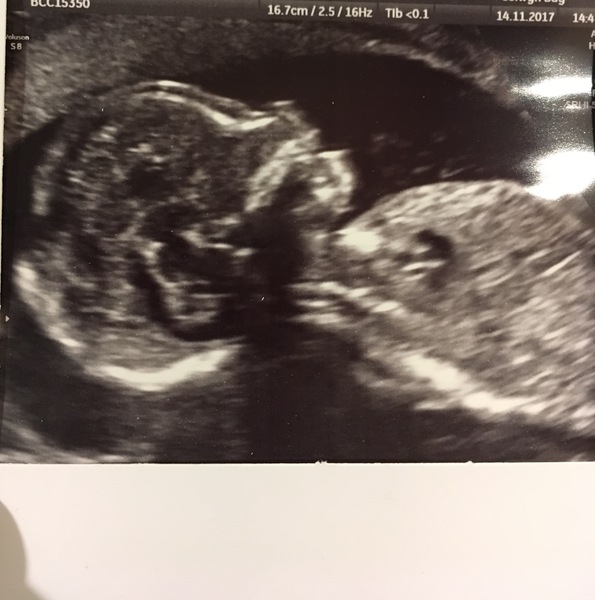 20 week scan today!