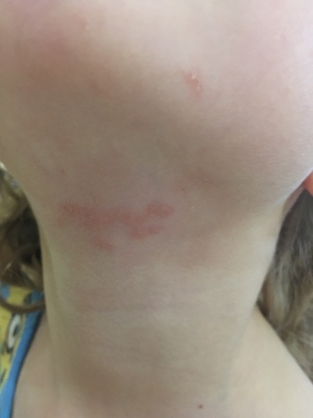 Eczema?