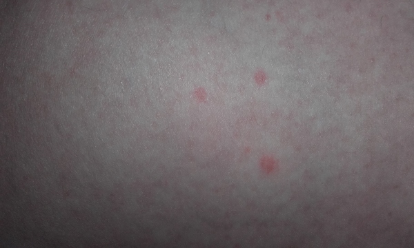 strange rash on legs