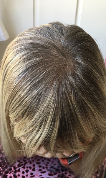 Hair loss support thread