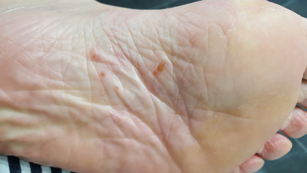 To ask what these funny things are on my foot?
