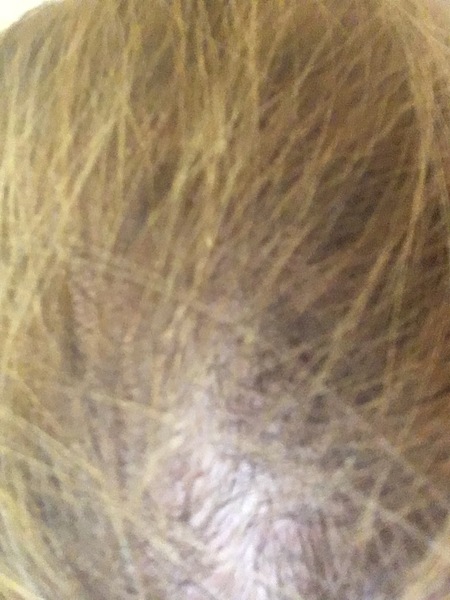 Hair loss support thread