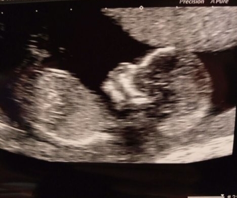 May 2018 thread 3, 12 week scans and heading towards the 2nd trimester