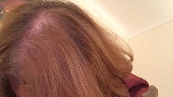 Hair loss support thread