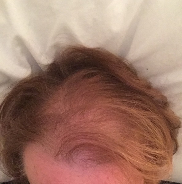 Hair loss support thread