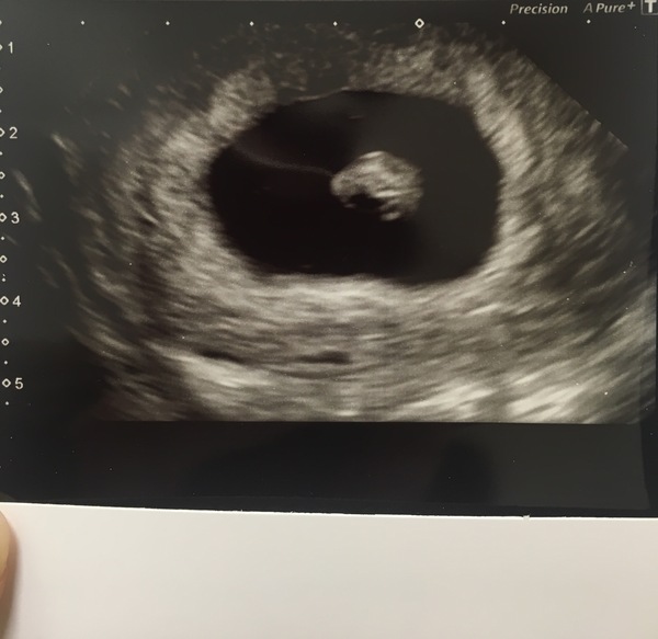 Picture of 7 early scan :-)