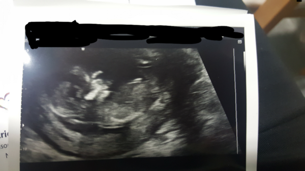 Boy or Girl?