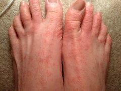 Severe rash