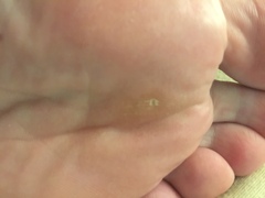 Are these veruccas?