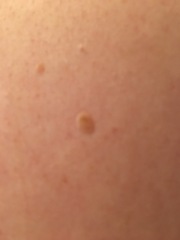 2 new moles age 34