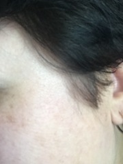Those of you who have had secret Botox...