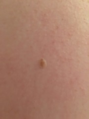 2 new moles age 34