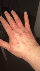 Hand foot and mouth in adults