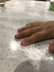 Finger Clubbing