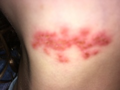 Eczema?