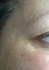 Those of you who have had secret Botox...