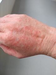 Severe rash
