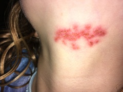 Eczema?